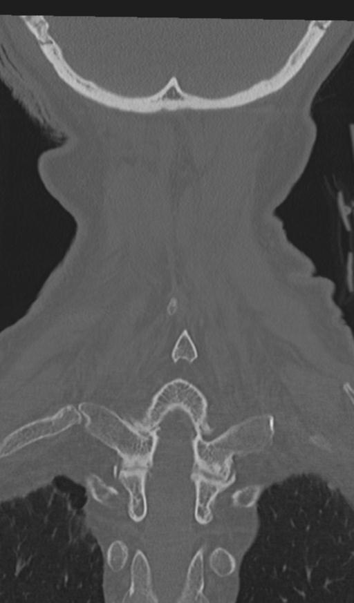 Acute on chronic subdural hematoma and thoracic vertebral injury in a multitrauma patient (Radiopaedia 31698-32619 Coronal bone window 57).jpg