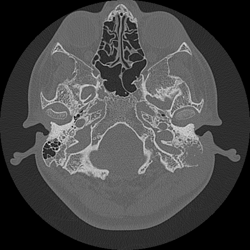 Acute otomastoiditis and Bezold abscess (Radiopaedia 88184-104786 Axial bone window 22).jpg