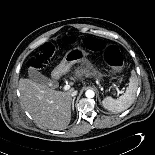 File:Acute pancreatic necrosis (Radiopaedia 13560-13486 Axial C+ portal venous phase 42).jpg