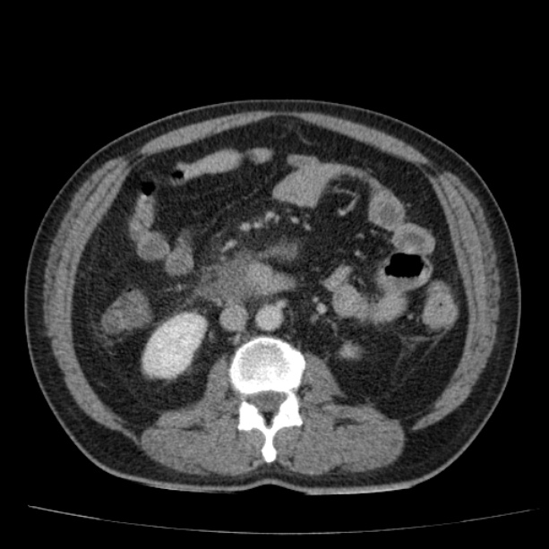 Acute pancreatitis (Radiopaedia 26663-26813 Axial C+ portal venous phase 44).jpg