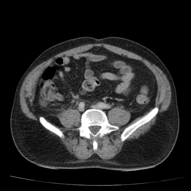 Acute pancreatitis (Radiopaedia 26663-26813 Axial C+ portal venous phase 58).jpg