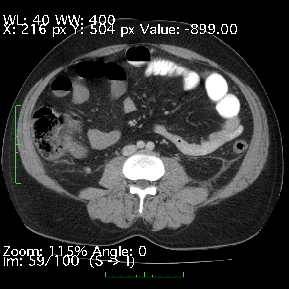 Acute pancreatitis (Radiopaedia 34043-35276 Axial C+ portal venous phase 59).jpg
