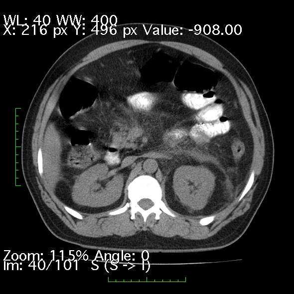 Acute pancreatitis (Radiopaedia 34043-35276 Axial non-contrast 40).jpg