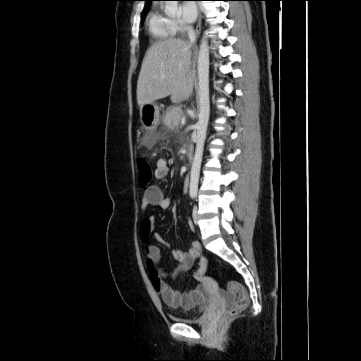 Acute pancreatitis (Radiopaedia 69236-79012 Sagittal C+ portal venous phase 51).jpg