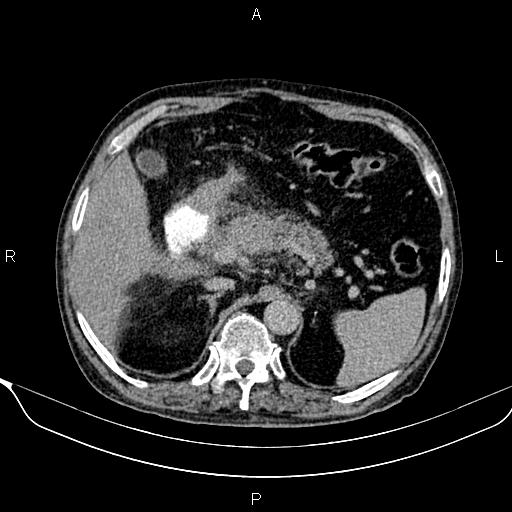 File:Acute pancreatitis (Radiopaedia 85146-100701 Axial C+ delayed 20).jpg