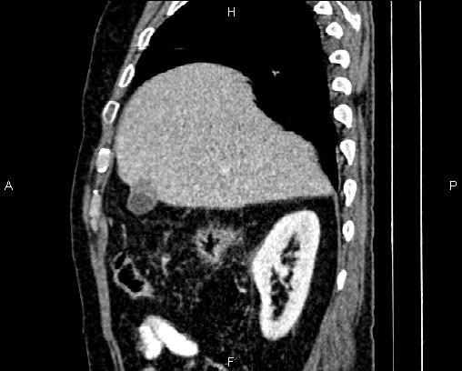 Acute pancreatitis (Radiopaedia 85146-100701 Sagittal C+ portal venous phase 20).jpg