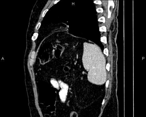 Acute pancreatitis (Radiopaedia 85146-100701 Sagittal C+ portal venous phase 81).jpg