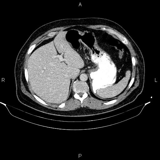 Acute pancreatitis (Radiopaedia 85390-101010 Axial C+ portal venous phase 21).jpg
