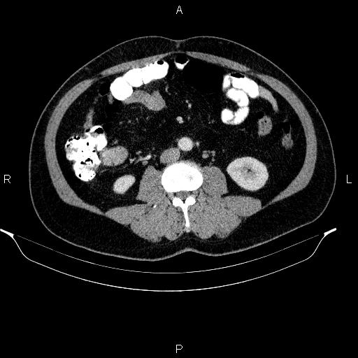 Acute pancreatitis (Radiopaedia 85390-101010 Axial C+ portal venous phase 60).jpg
