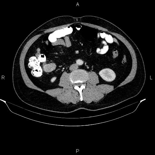 Acute pancreatitis (Radiopaedia 85390-101010 Axial C+ portal venous phase 61).jpg