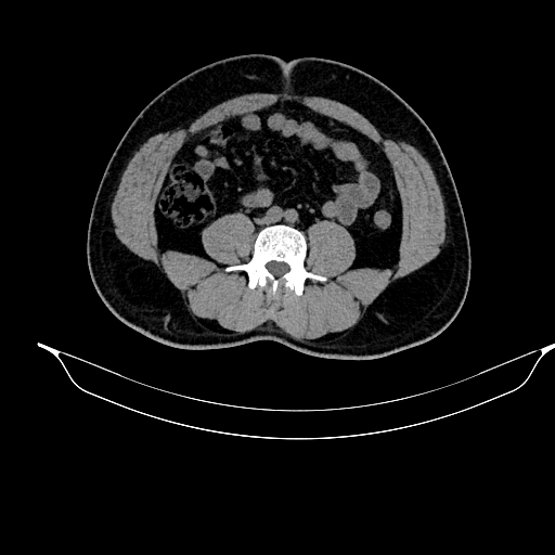 File:Acute pancreatitis (Radiopaedia 87428-103757 Axial non-contrast 61).jpg