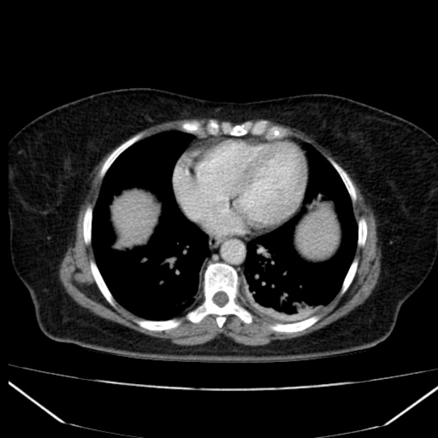 Acute pancreatitis - Balthazar C (Radiopaedia 26569-26714 Axial C+ portal venous phase 14).jpg