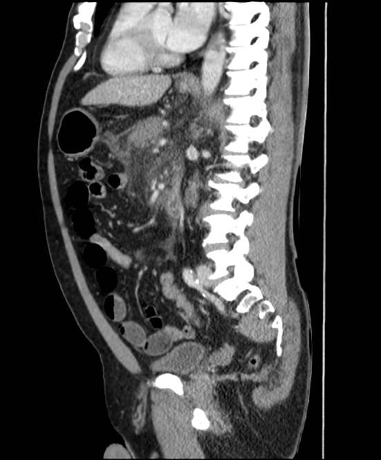 Acute pancreatitis - Balthazar E (Radiopaedia 23080-23110 Sagittal C+ portal venous phase 56).jpg