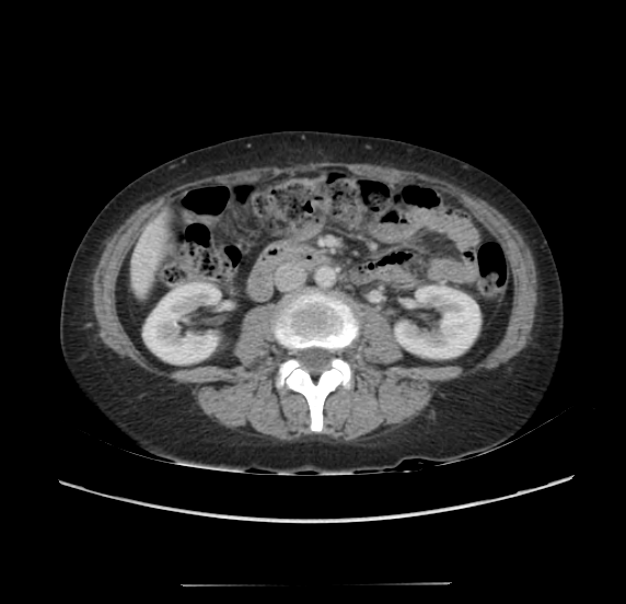 File:Acute pancreatitis - Balthazar E - post ERCP (Radiopaedia 27562-27772 Axial C+ portal venous phase 38).png