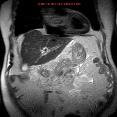 File:Acute pancreatitis with incidental pancreatic lipoma (Radiopaedia 10190-10732 Coronal T2 10).jpg