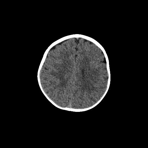 Acute phase of hemiconvulsion-hemiplegia epilepsy syndrome (Radiopaedia 29309-29744 Axial non-contrast 17).jpg