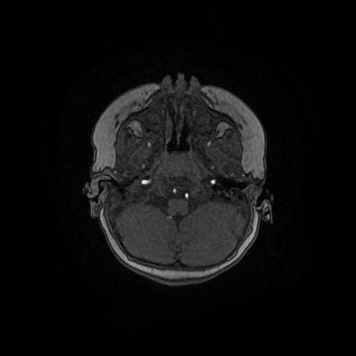 File:Acute phase of hemiconvulsion-hemiplegia epilepsy syndrome (Radiopaedia 29309-29745 Axial TOF angiography 132).jpg