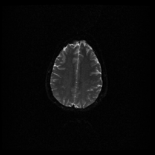 File:Acute pontine infarct from vertebral artery dissection (Radiopaedia 34111-35370 Axial DWI 40).png
