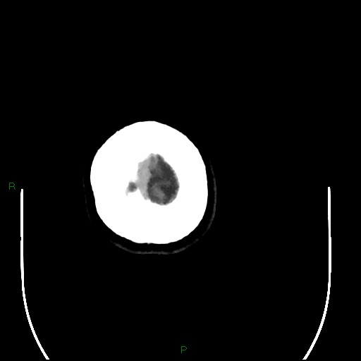 Acute posterior cerebral artery territory infarct (Radiopaedia 79329-92393 Axial non-contrast 108).jpg