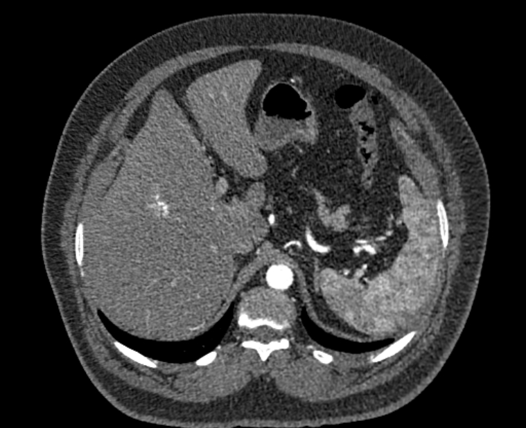 Acute pulmonary embolism with pulmonary infarcts (Radiopaedia 77688-89908 Axial C+ CTPA 71).jpg