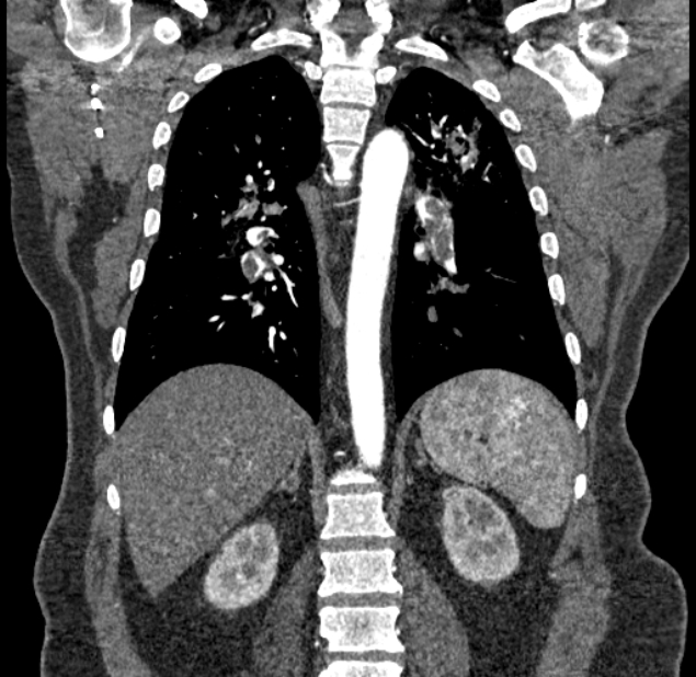 Acute pulmonary embolism with pulmonary infarcts (Radiopaedia 77688-89908 Coronal C+ CTPA 67).jpg