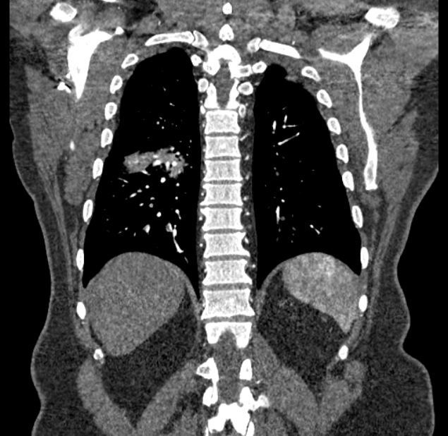 Acute pulmonary embolism with pulmonary infarcts (Radiopaedia 77688-89908 Coronal C+ CTPA 80).jpg