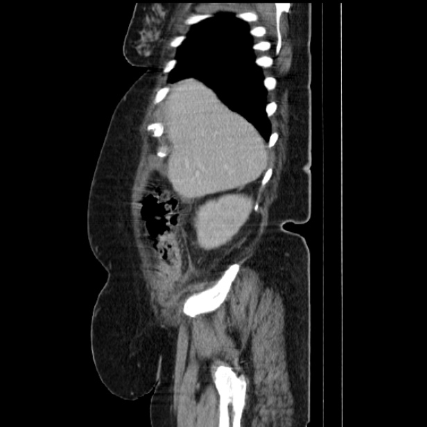 Acute pyelonephritis (Radiopaedia 25657-25837 Sagittal renal parenchymal phase 21).jpg