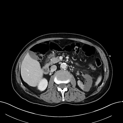 Acute renal infarction (Radiopaedia 59375-66736 Axial C+ portal venous phase 39).jpg