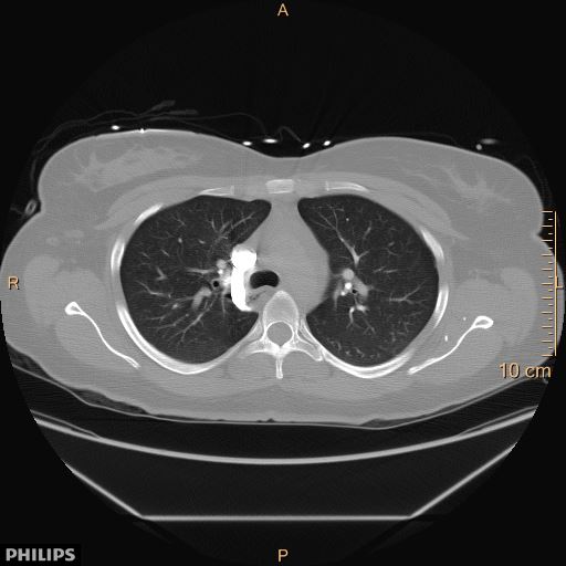 File:Acute reversible pulmonary hypertension and right heart failure from cocaine toxicity (Radiopaedia 49394-54517 Axial 9).jpg