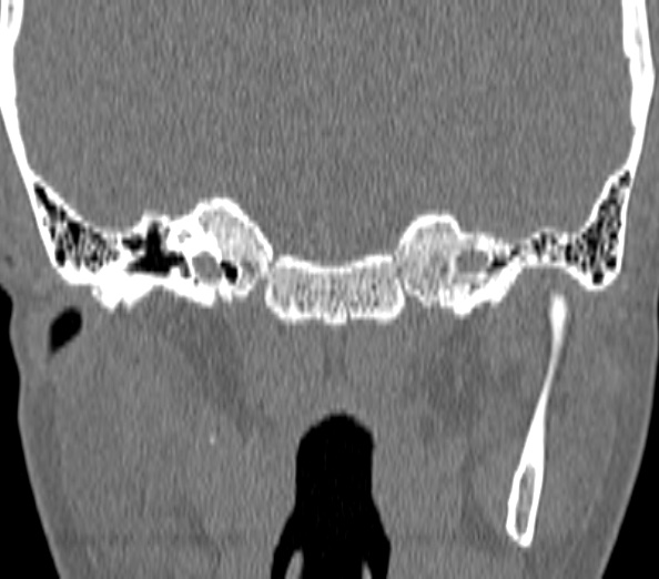 Acute sinusitis (Radiopaedia 40564-43158 Coronal bone window 54).jpg