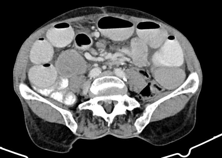 Acute small bowel (ileal) volvulus (Radiopaedia 71740-82139 Axial C+ portal venous phase 134).jpg