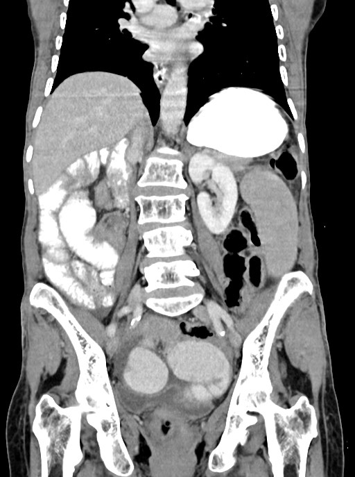 Acute small bowel (ileal) volvulus (Radiopaedia 71740-82139 Coronal C+ portal venous phase 68).jpg