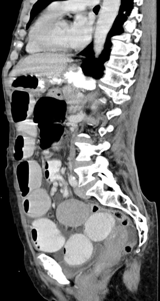 Acute small bowel (ileal) volvulus (Radiopaedia 71740-82139 Sagittal C+ portal venous phase 77).jpg