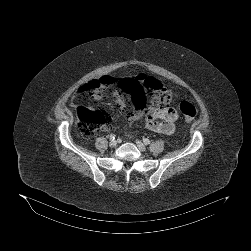 File:Acute superior mesenteric artery occlusion (Radiopaedia 51288-56960 Axial C+ portal venous phase 72).jpg