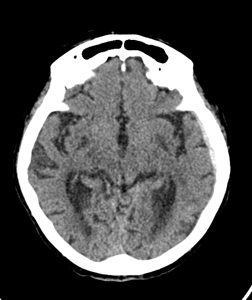 Acute traumatic subdural hematoma (Radiopaedia 82921-97257 Axial non-contrast 38).jpg