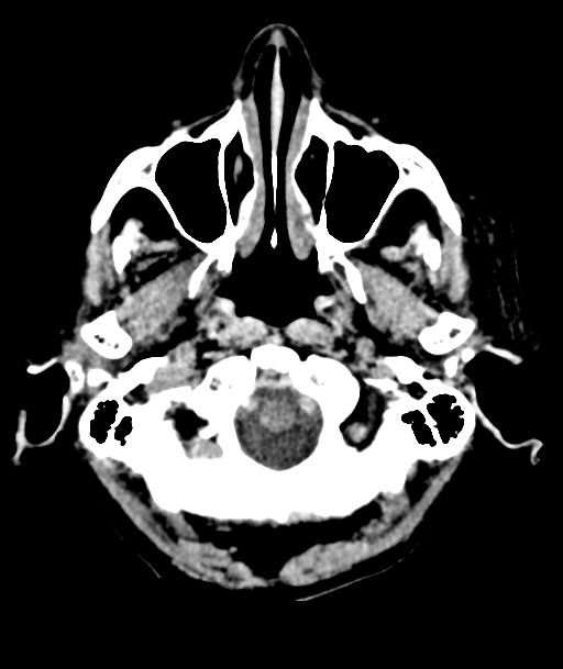 Acute traumatic subdural hematoma (Radiopaedia 82921-97257 Axial non-contrast 58).jpg