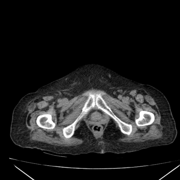 Acute tubular necrosis (Radiopaedia 28077-28334 Axial non-contrast 71).jpg