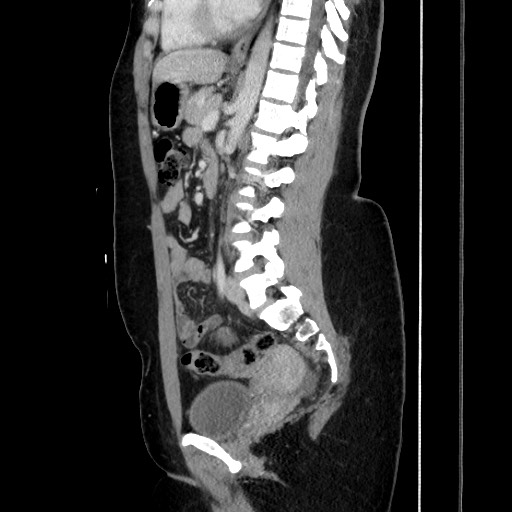 File:Acute uncomplicated appendicitis (Radiopaedia 73704-84499 Sagittal C+ portal venous phase 122).jpg