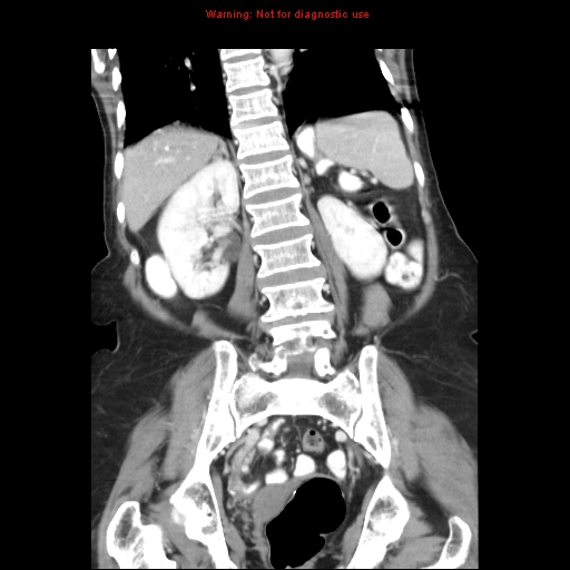 File:Adenocarcinoma of the colon (Radiopaedia 8191-9039 Coronal liver window 32).jpg