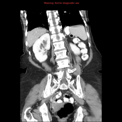 File:Adenocarcinoma of the colon (Radiopaedia 8191-9039 Coronal liver window 34).jpg