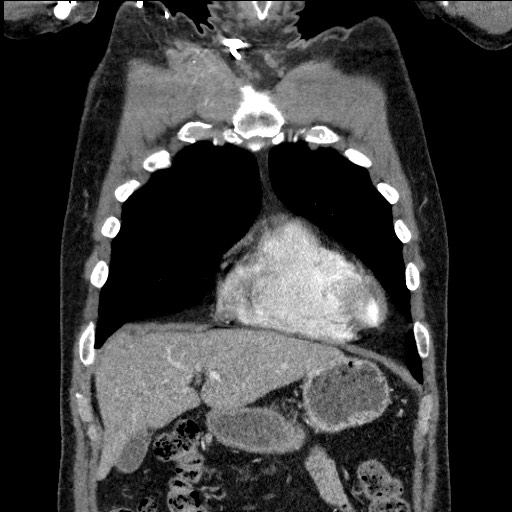 File:Adenocarcinoma of the lung (Radiopaedia 59871-67325 Coronal C+ arterial phase 13).jpg