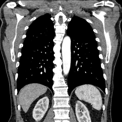 Adenocarcinoma of the lung (Radiopaedia 59871-67325 Coronal C+ arterial phase 51).jpg