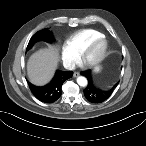 File:Adenocarcioma of rectum- T1 lesion (Radiopaedia 36921-38547 Axial C+ arterial phase 41).png