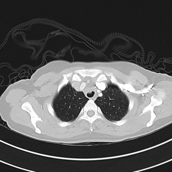 Adenocystic carcinoma of the trachea (Radiopaedia 47677-52525 Axial lung window 34).jpg