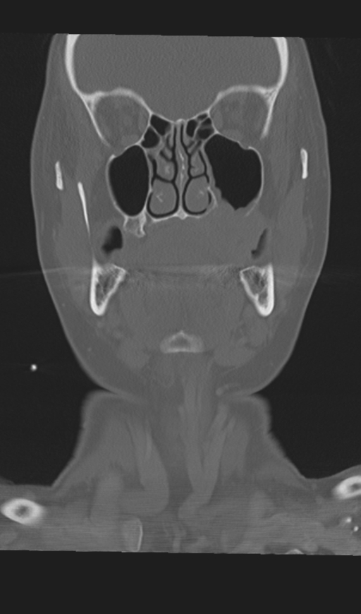 Adenoid cystic tumor of palate (Radiopaedia 46980-51518 Coronal bone window 25).png