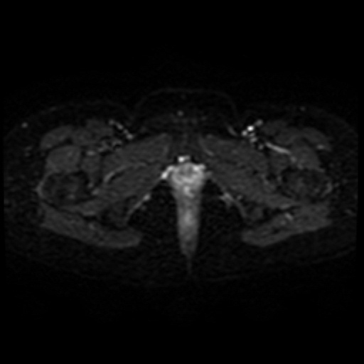 Adenoma malignum of cervix (Radiopaedia 66441-75705 Axial DWI 23).jpg