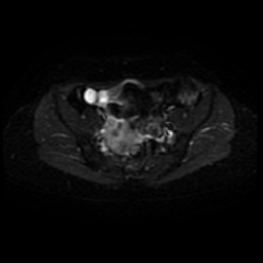 Adenoma malignum of cervix (Radiopaedia 66441-75705 Axial DWI 5).jpg
