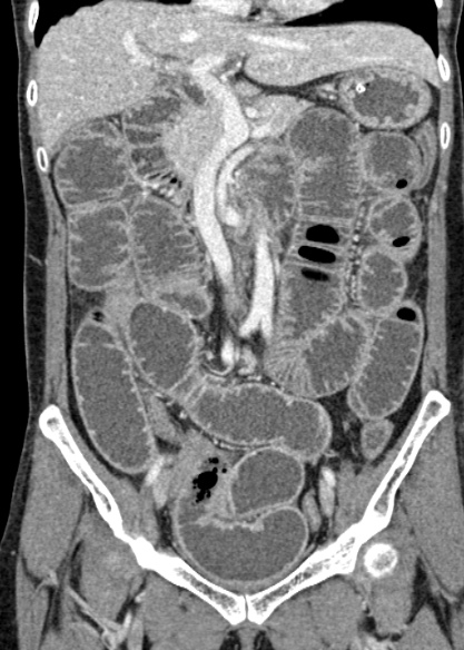 Adhesional small bowel obstruction (Radiopaedia 48397-53305 Coronal C+ portal venous phase 152).jpg