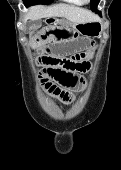 File:Adhesional small bowel obstruction (Radiopaedia 48397-53305 Coronal C+ portal venous phase 63).jpg