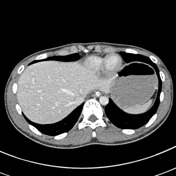 Adhesional small bowel obstruction (Radiopaedia 52107-57980 Axial C+ portal venous phase 12).jpg